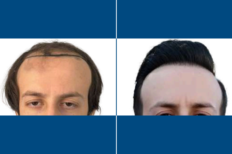 Low-Level Laser Therapy (LLLT) 1