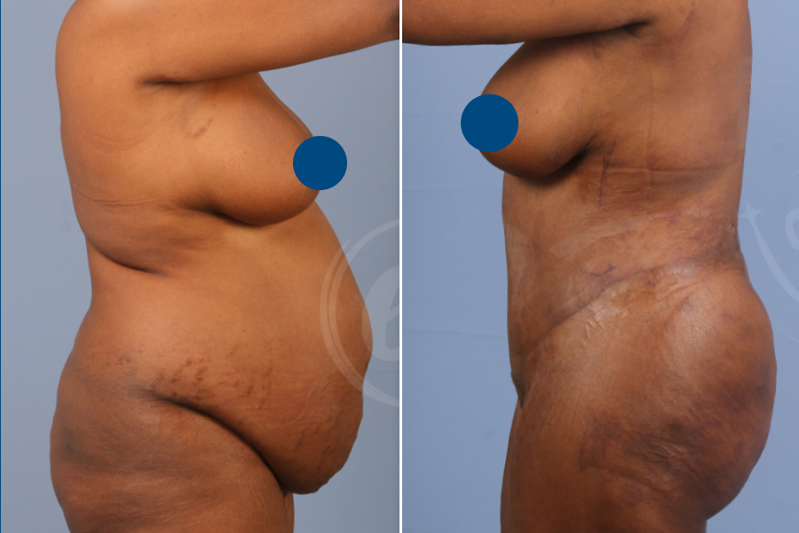 Liposuction 1