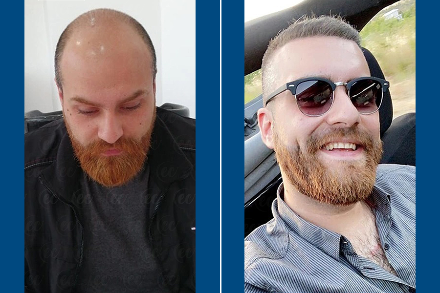 Long DHI Hair Transplantation: Fuller Hair, Naturally