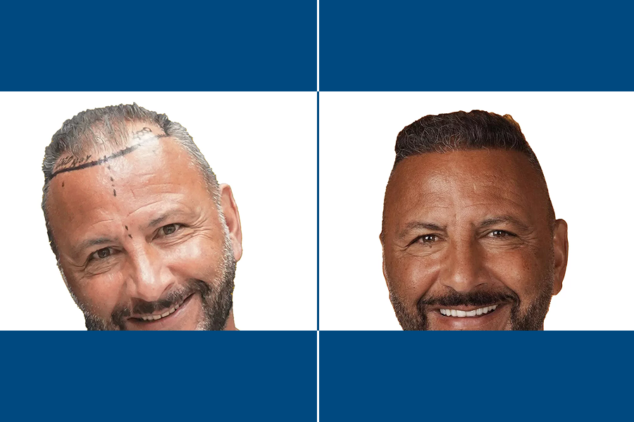 Long DHI Hair Transplantation: Fuller Hair, Naturally