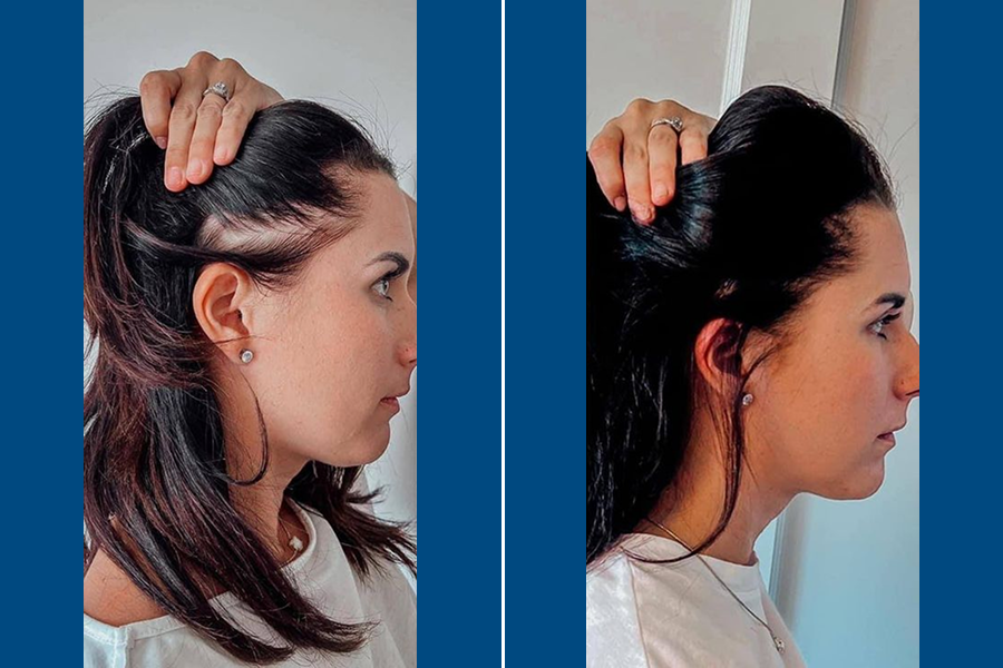 Low-Level Laser Therapy (LLLT) 1