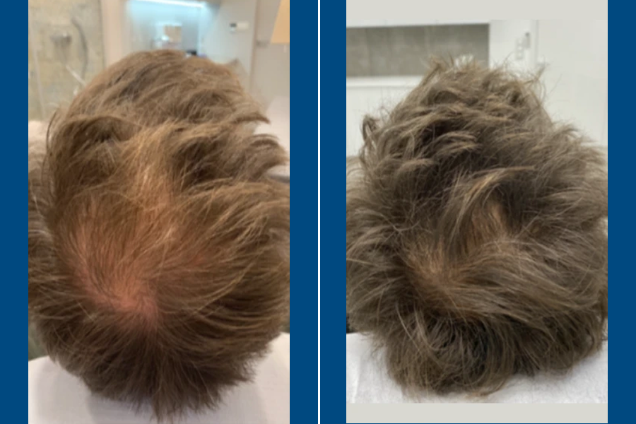 Low-Level Laser Therapy (LLLT) 2