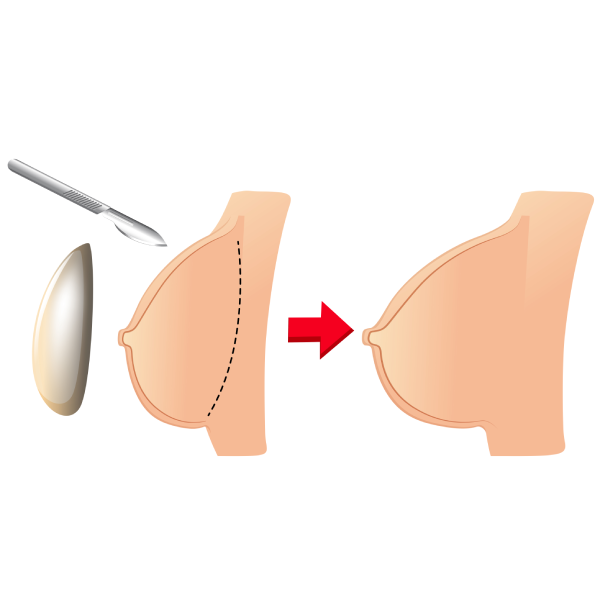 Breast Augmentation