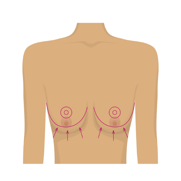 Breast Reduction