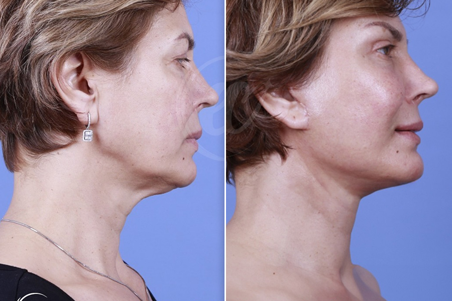 Neck Lift