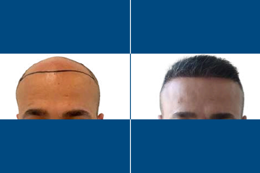 Needle-Free Hair Transplantation: Regrow Hair Comfortably