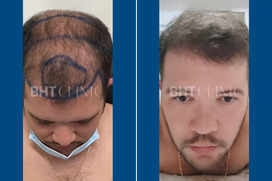 No-Shave Hair Transplantation: Regrow Hair Seamlessly