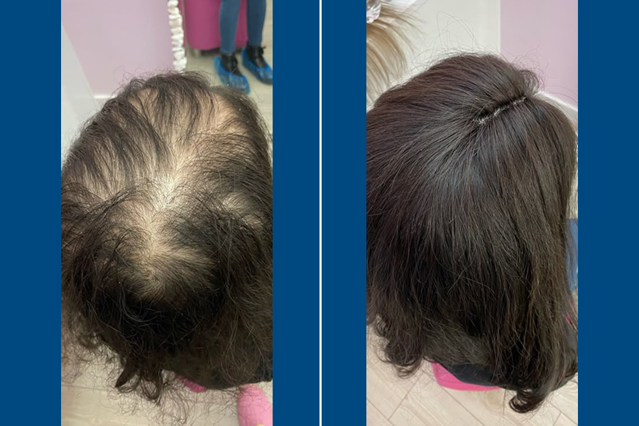 No-Shave Hair Transplantation: Regrow Hair Seamlessly