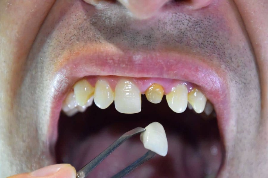 PFM Crown (Porcelain-Fused-to-Metal) 2