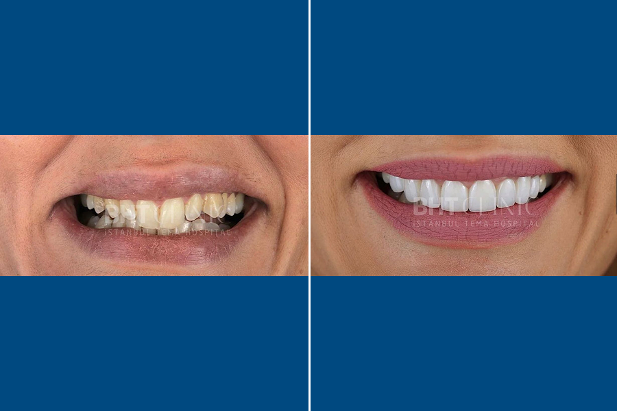 Porcelain Laminate Veneer 5