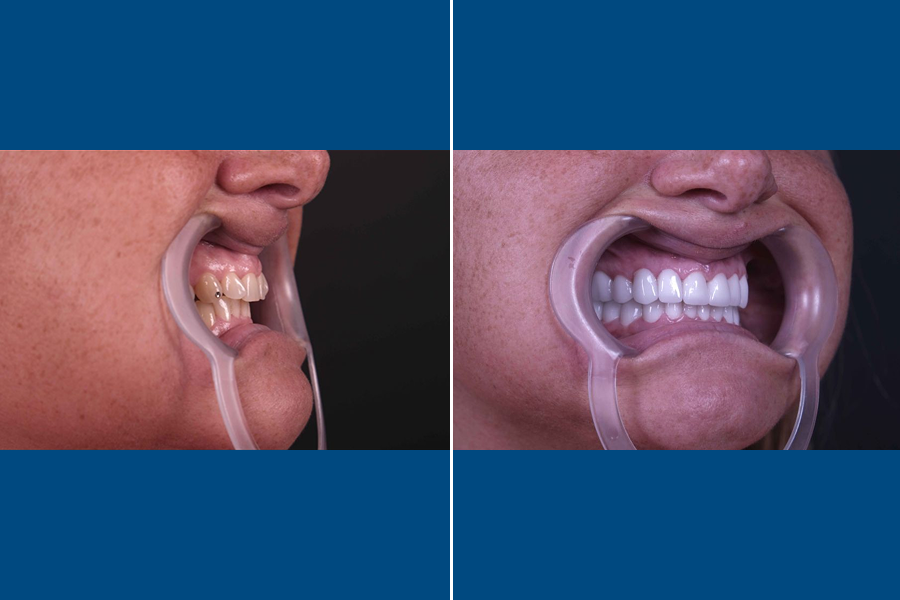 Porcelain Laminate Veneer 1