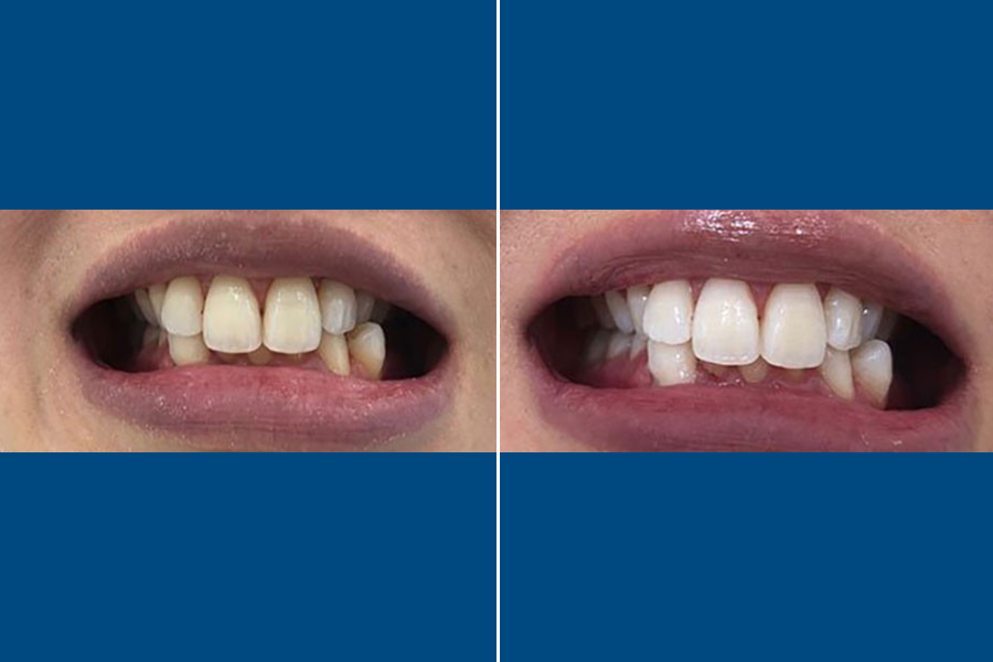 Professional Teeth Whitening 3