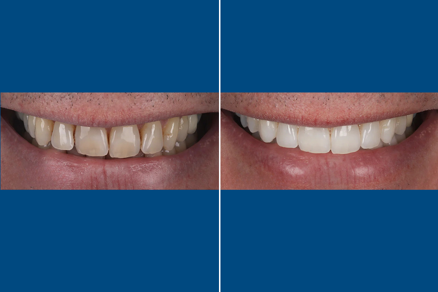 Professional Teeth Whitening 4