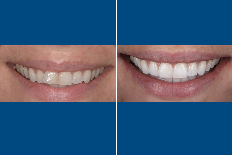Professional Teeth Whitening 1