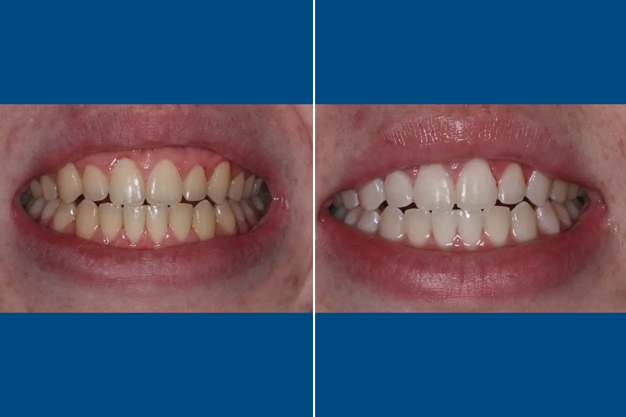 Professional Teeth Whitening 2
