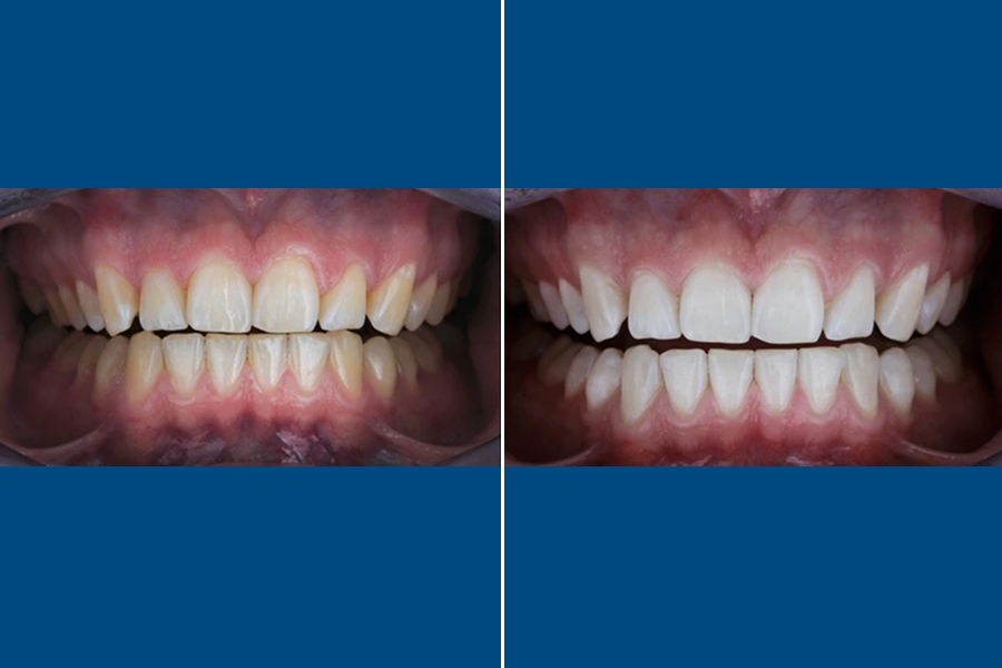 Professional Teeth Whitening 5