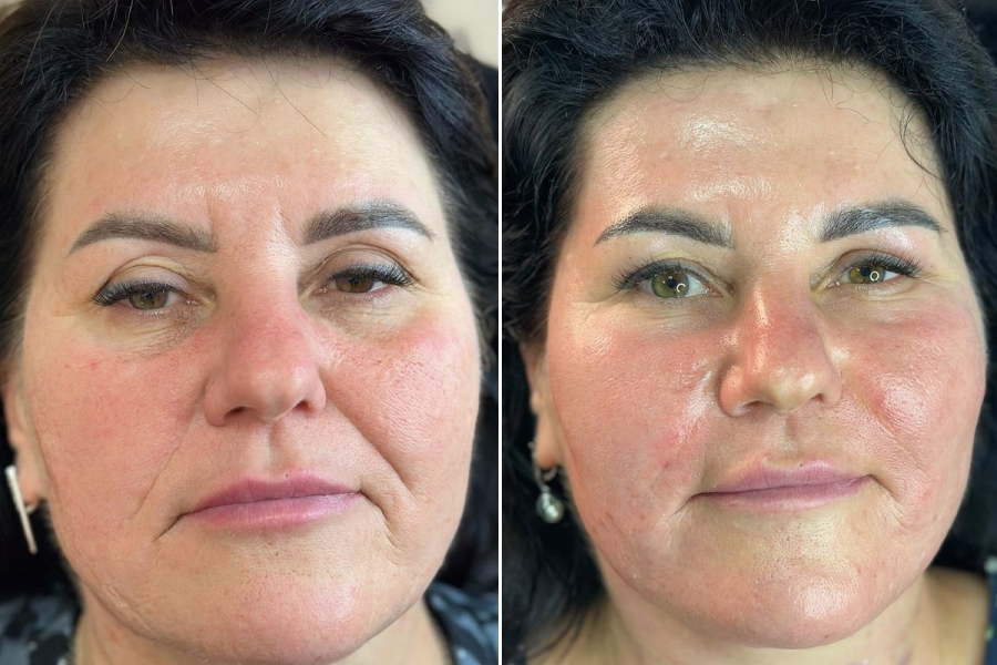 PRP Facial Rejuvenation