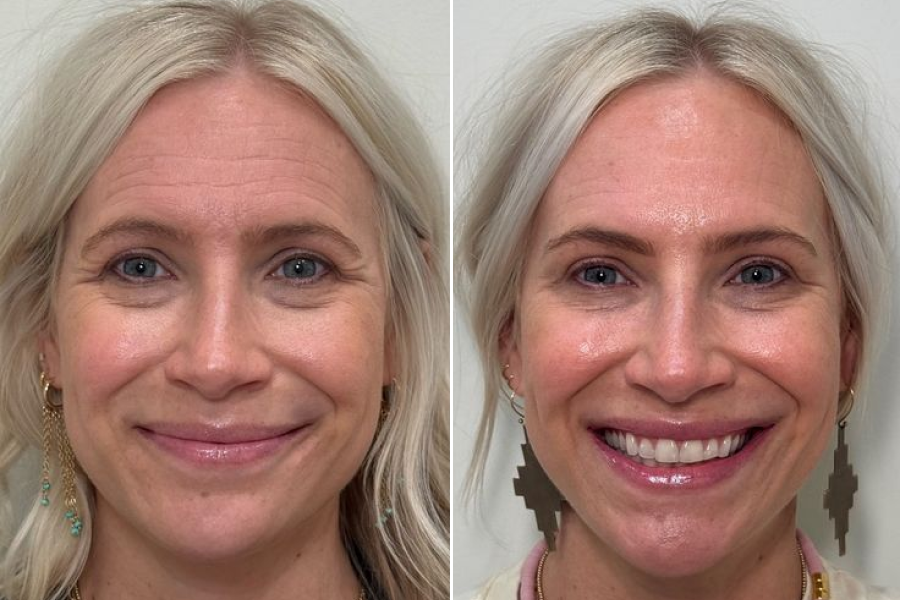 PRP Facial Rejuvenation