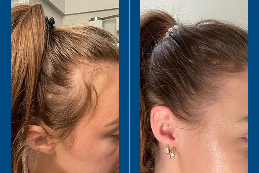 PRP Hair Therapy: Revitalize Your Roots