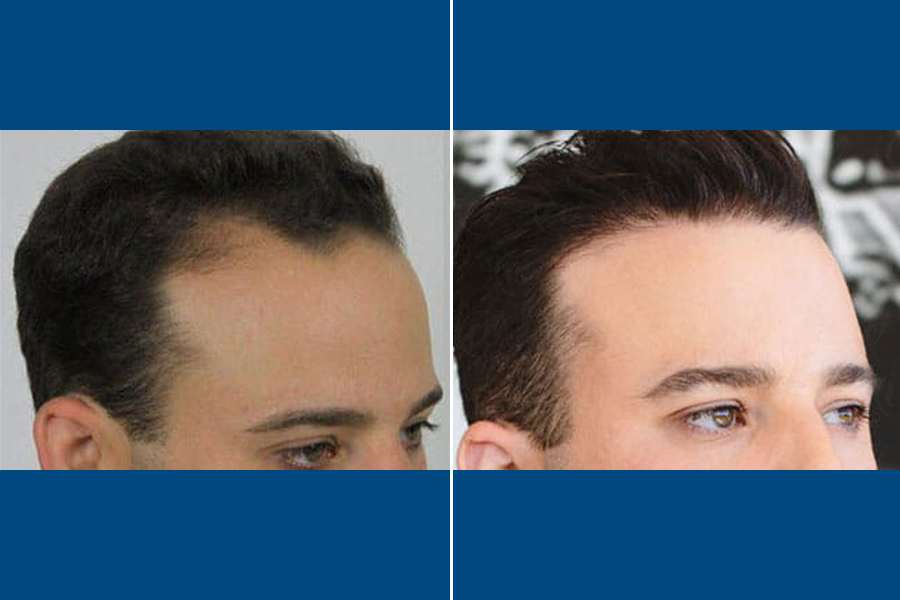 PRP Hair Therapy: Revitalize Your Roots