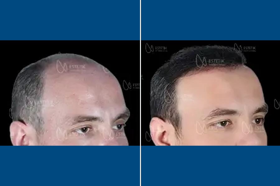 PRP Hair Therapy: Revitalize Your Roots