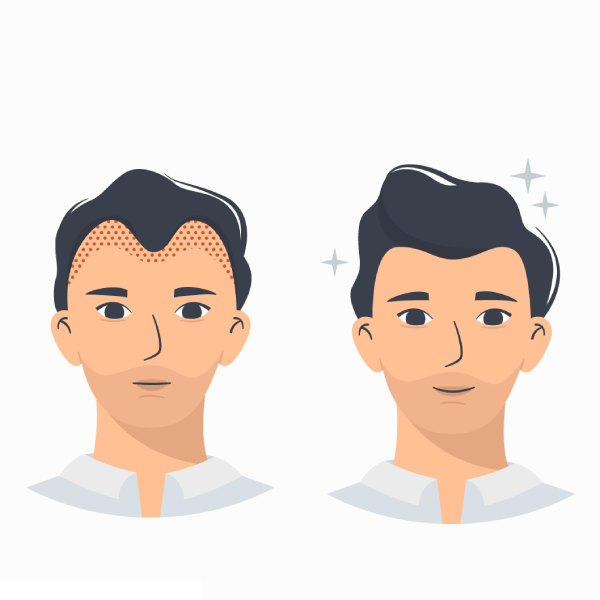 Revision Hair Transplantation