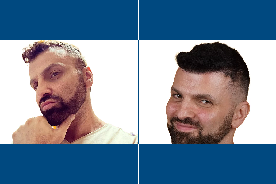 Revision Hair Transplantation: Restore Your Roots