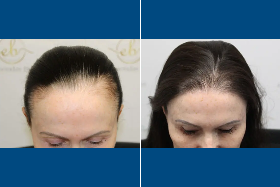 Revision Hair Transplantation: Restore Your Roots