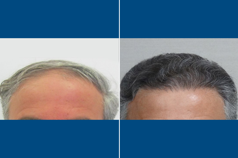 Revision Hair Transplantation: Restore Your Roots