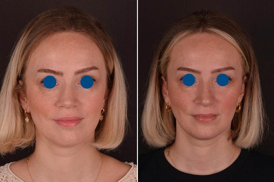 Revision Rhinoplasty