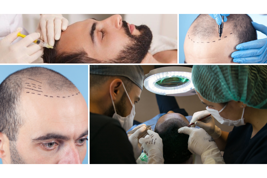 Hair Mesotherapy