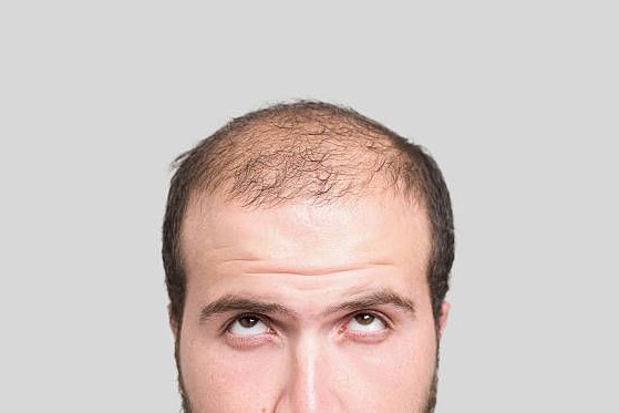 Hair Mesotherapy
