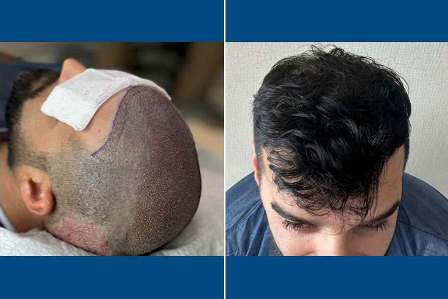 Sapphire FUE Hair Transplantation: Shine with New Hair