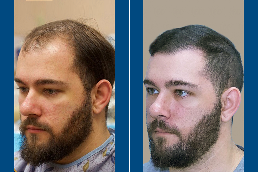 Sapphire FUE Hair Transplantation: Shine with New Hair