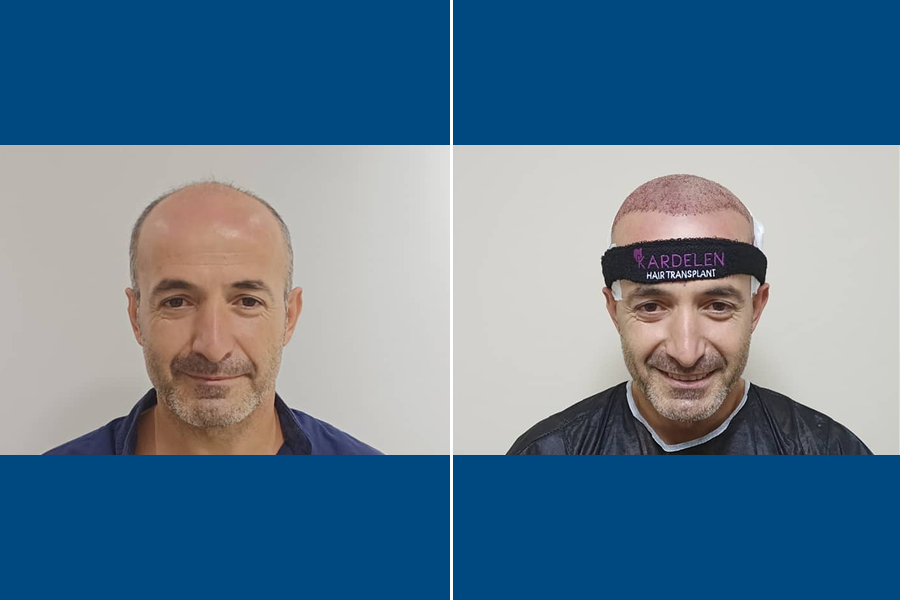 Sapphire FUE Hair Transplantation: Shine with New Hair