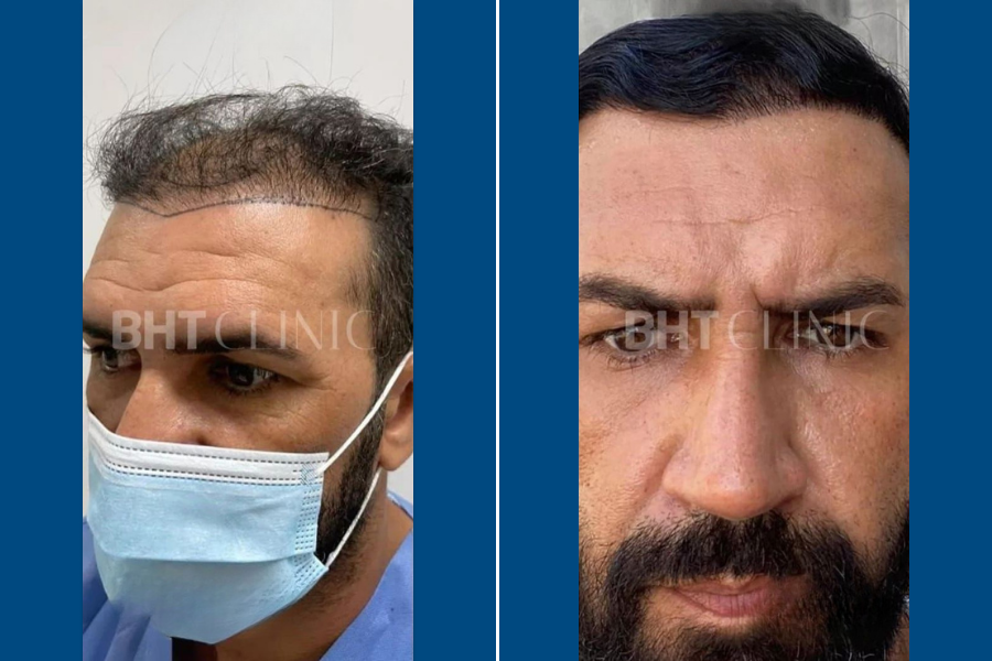 SDHI Hair Transplantation: Restore Fuller Hair