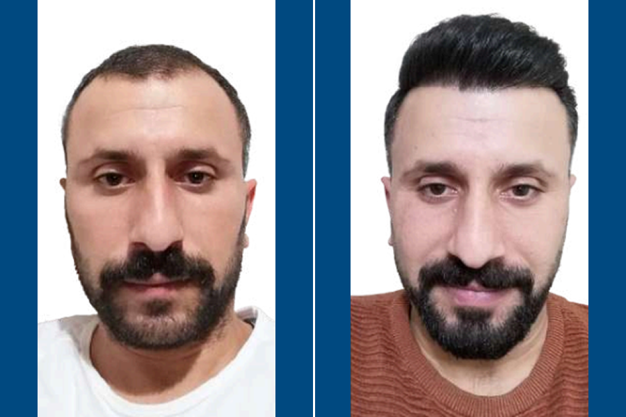 SDHI Hair Transplantation: Restore Fuller Hair