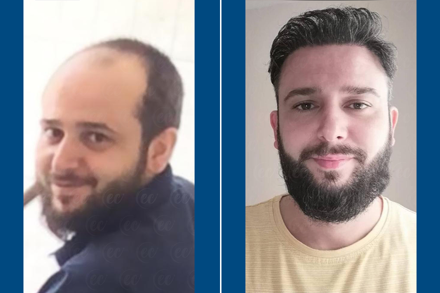 Shaven Hair Transplantation: Renew Your Roots