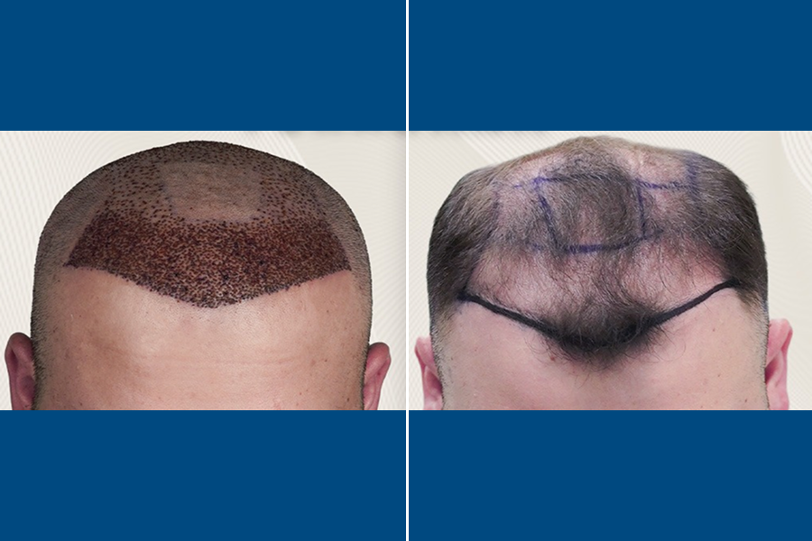 Shaven Hair Transplantation: Renew Your Roots