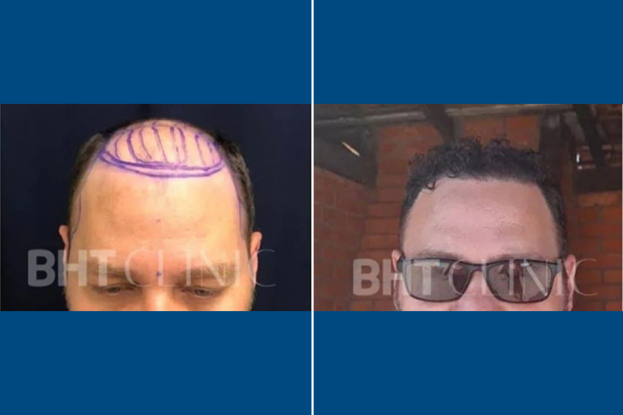 Shaven Hair Transplantation: Renew Your Roots