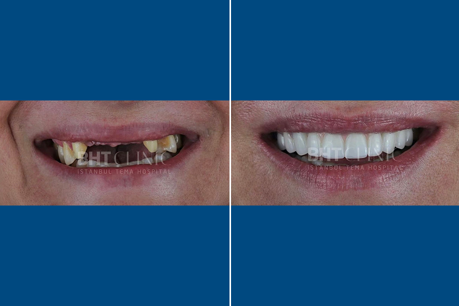 Single Dental Implant 2