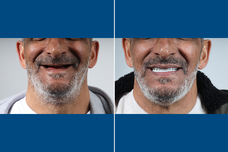 Single Dental Implant 4