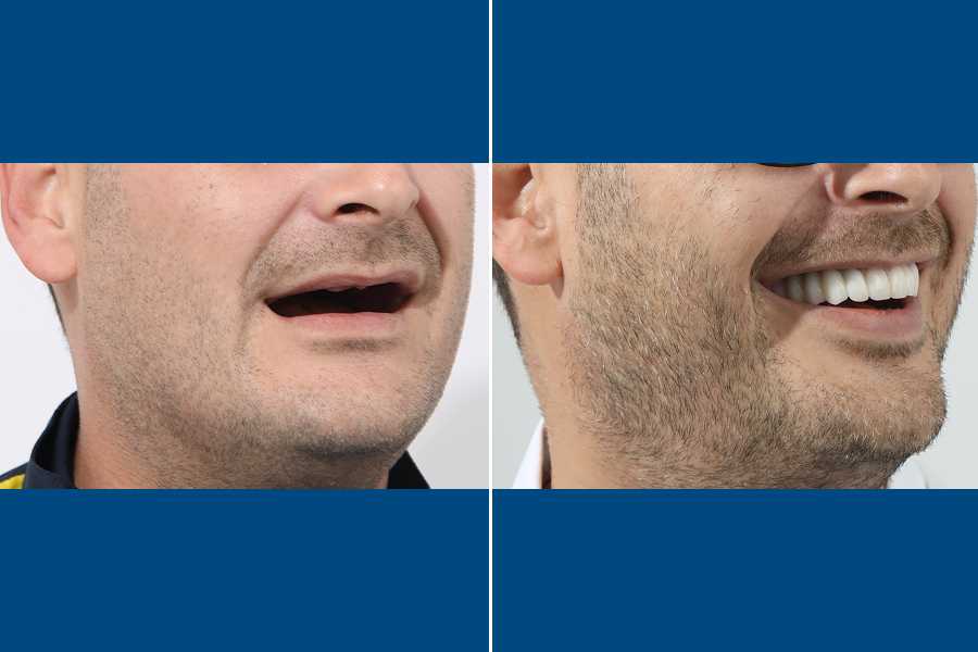 Single Dental Implant 3