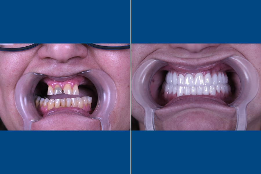 Single Dental Implant 1