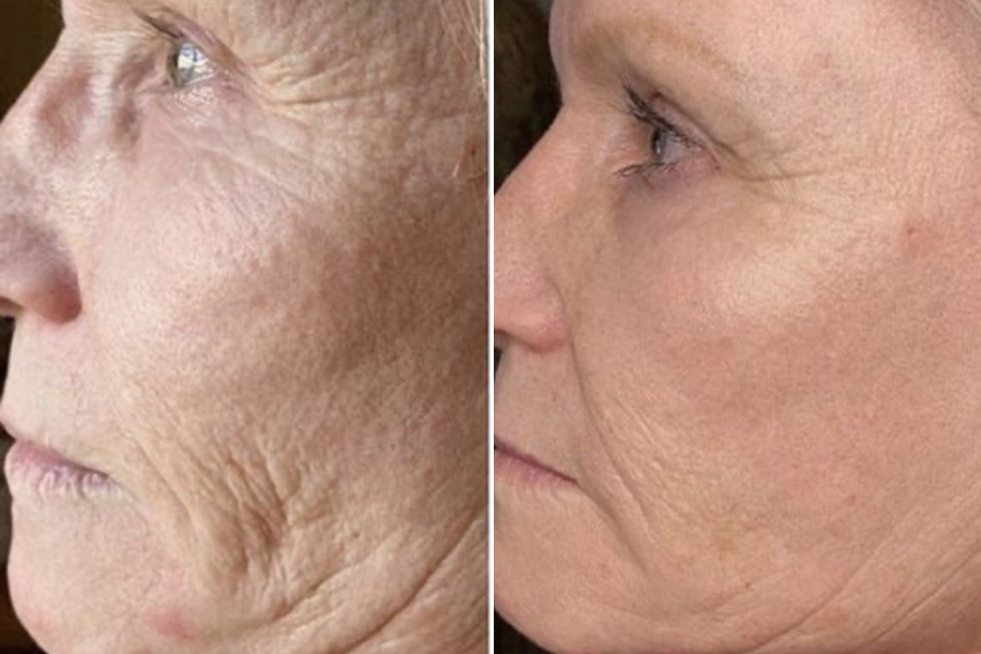 Thermage CPT Therapy