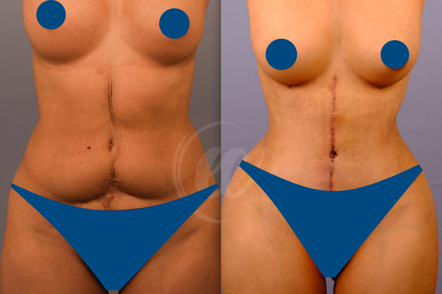 Tummy Tuck 2