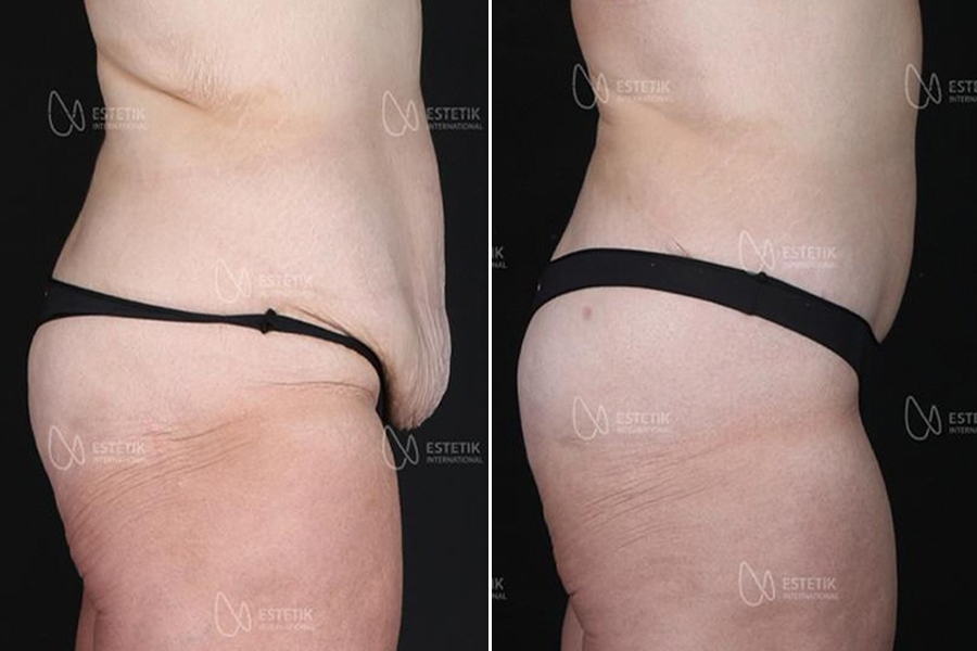 Tummy Tuck 5