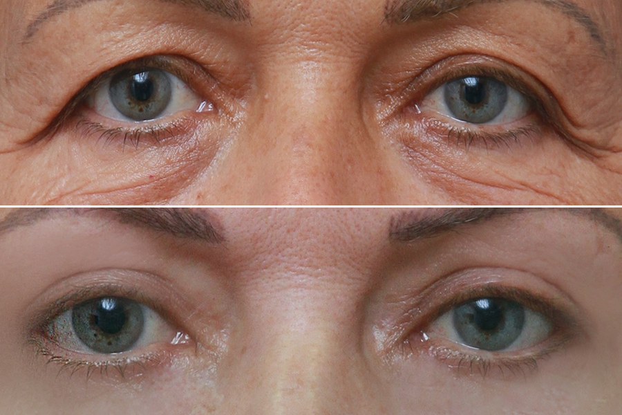 Under-Eye Light Filler