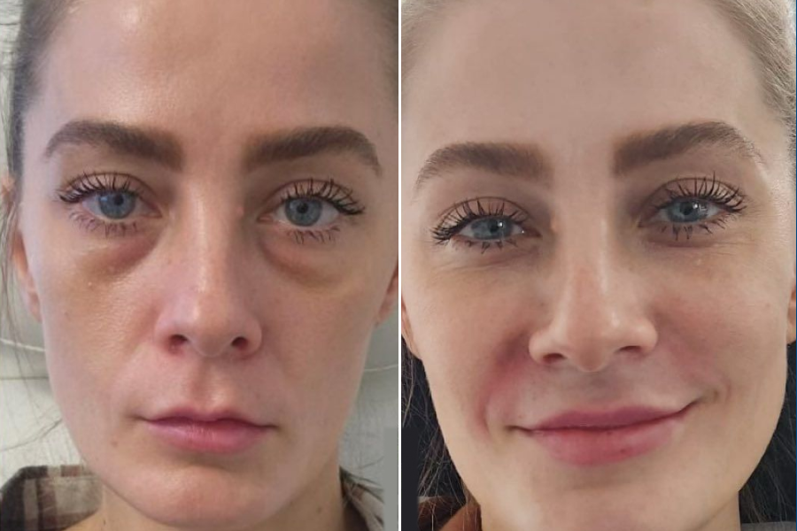 Under-Eye Light Filler