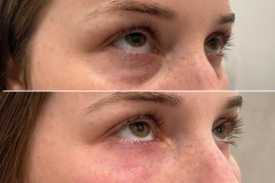 Under-Eye Light Filler